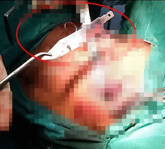 Göğüs ağrısıyla hastaneye gitti, göğsünde 8 yıldır bıçakla yaşadığı ortaya çıktı!